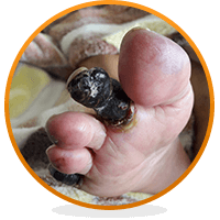 Gangrene is one of the possible side effects of injecting heroin.