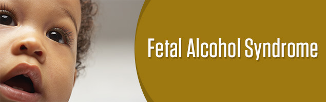 Fetal Alcohol Syndrome Pictures Of Adults