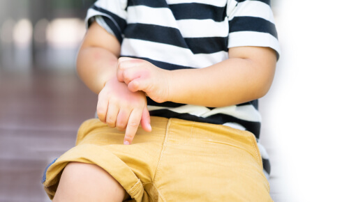 Il bambino ha allergie e prurito alla pelle