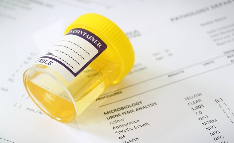 Urine sample container over a medical report.