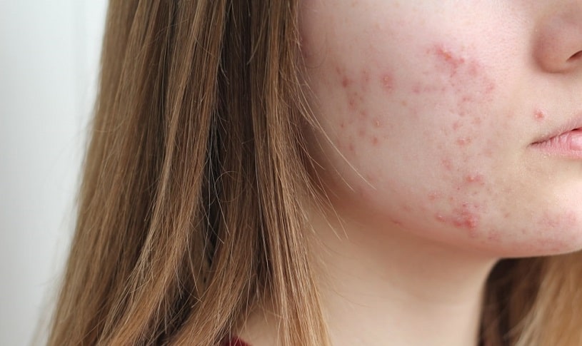 Close up of a woman with acne.