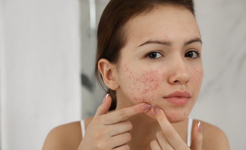 Woman with acne looking in the mirror.