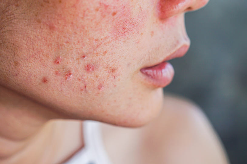 A person has acne and other problems with skin because of anabolic steroids use.